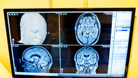 ct-bilde CT-bilde av pasient med Parkinsons sykdom